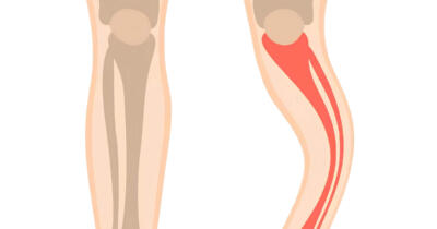 Paget Hastalığı: Belirtileri, Tedavisi ve Önleme Yöntemleri