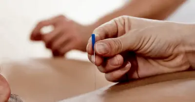 kuru-igne-tedavisi-nedir-neye-yarar