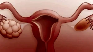 polikistik-over-sendromu-nedir