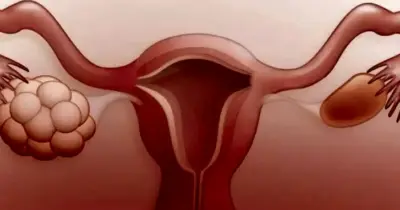 polikistik-over-sendromu-nedir